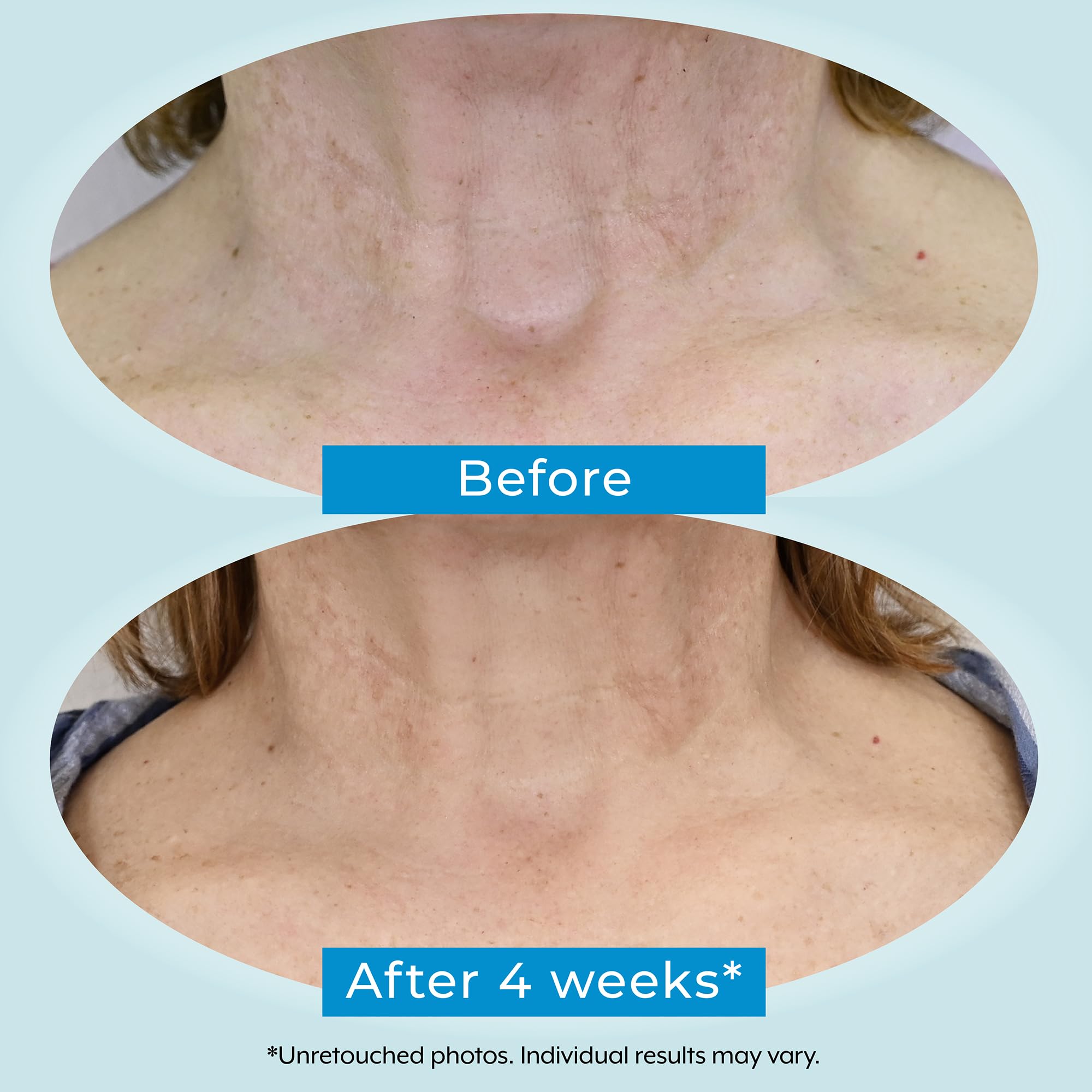 Plexaderm neck area sample demonstrates improved skin tone and radiance.
