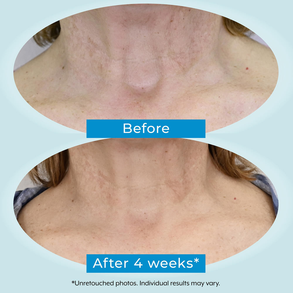 Plexaderm neck area sample demonstrates improved skin tone and radiance.