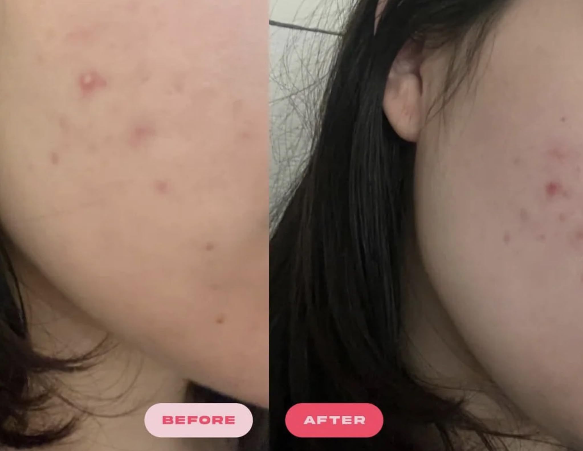 Plumpie Hydro Patch absorbs moisture to protect irritated skin