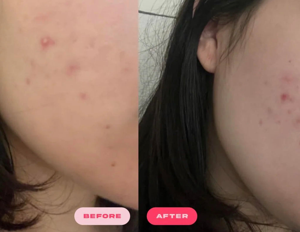 Plumpie Hydro Patch absorbs moisture to protect irritated skin