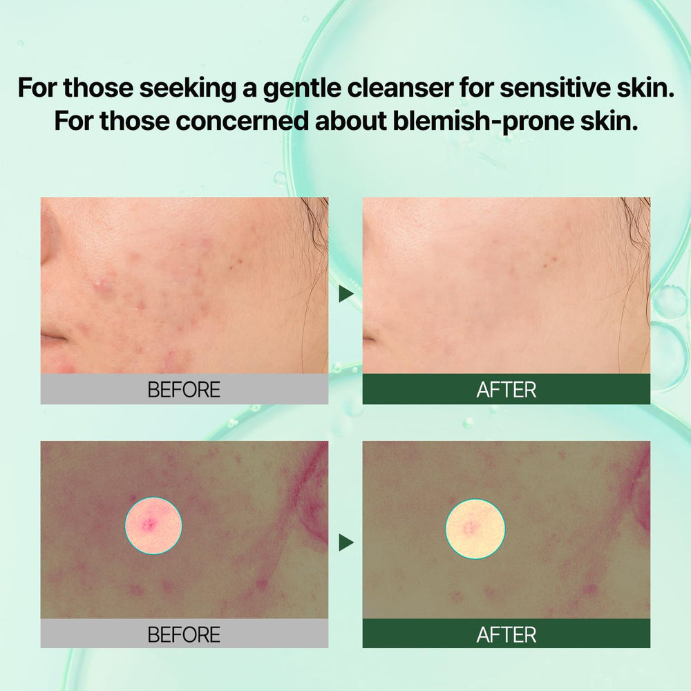 PONGDANG Pore Deep Clean on cheek showing sebum control potential.