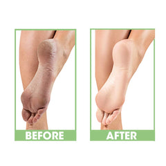 ProLinc Dry Heel Eliminator applied to heels for smooth, hydrated skin.
