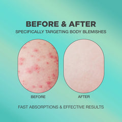 PROOT Butt Acne Cream texture spread across skin, demonstrating light, non-greasy absorption.