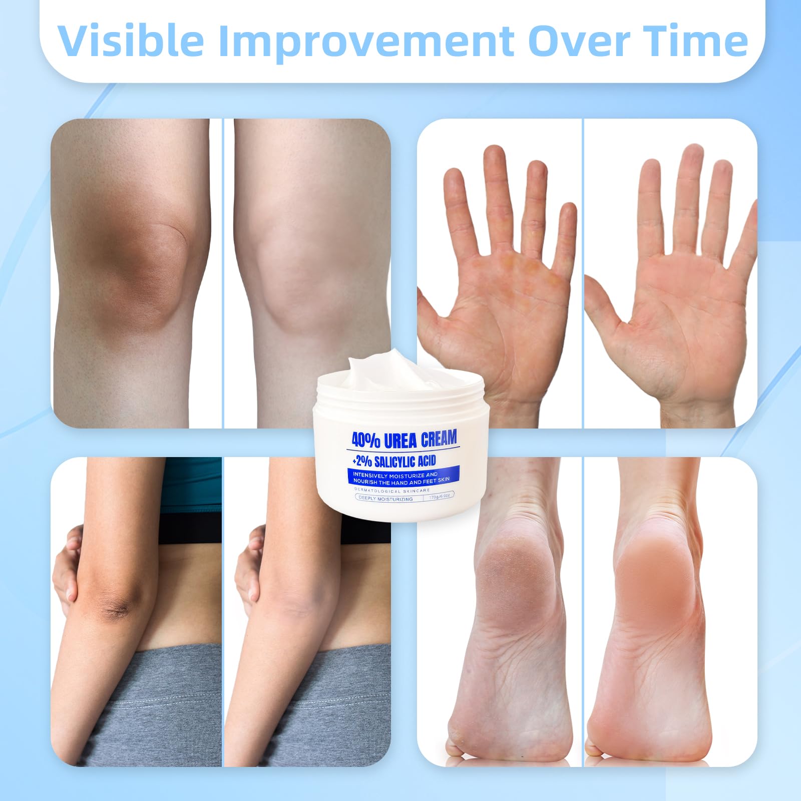 QQWIAX 40% Urea Cream absorbed into skin for lasting moisture