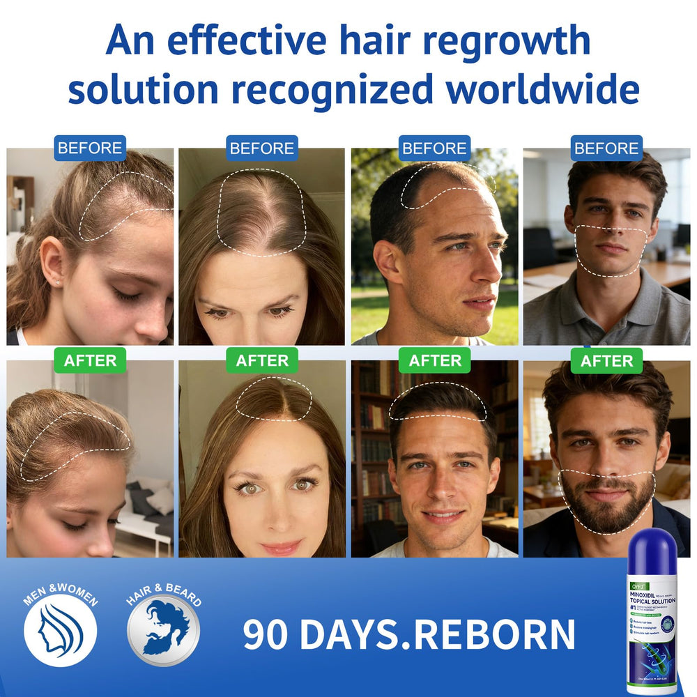 QYFJ minoxidil 5% bottle ready for daily use on a clean counter.