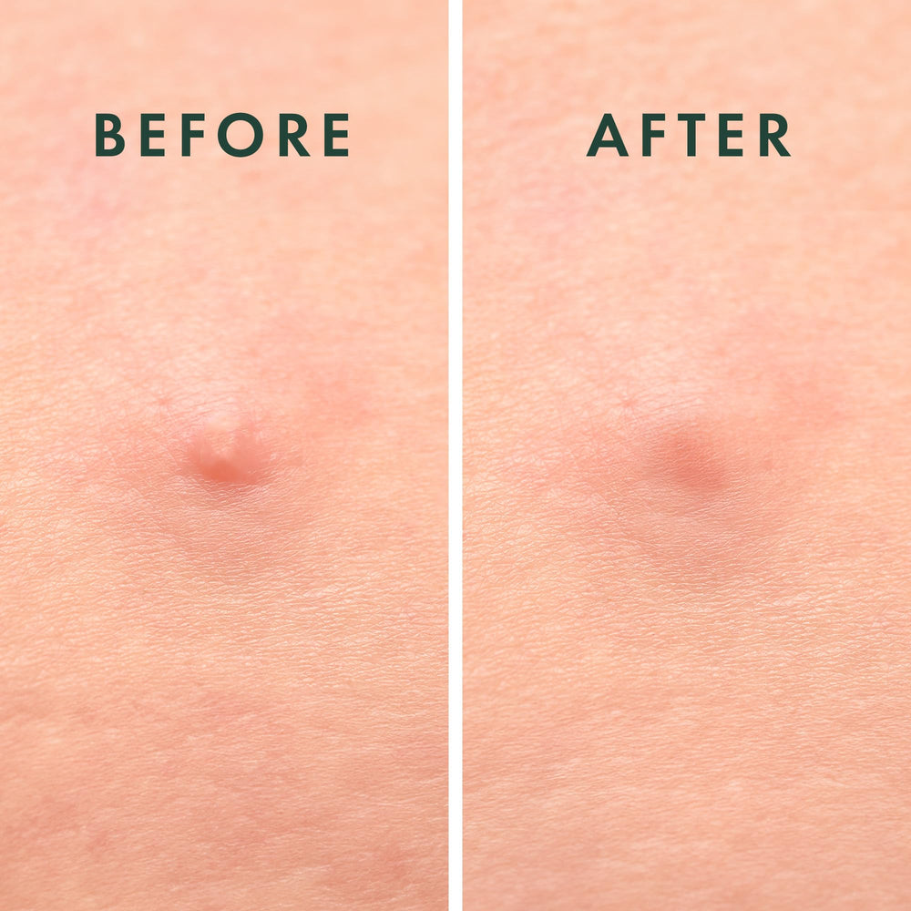 Rael patch with succinic acid for early blemish appearance.