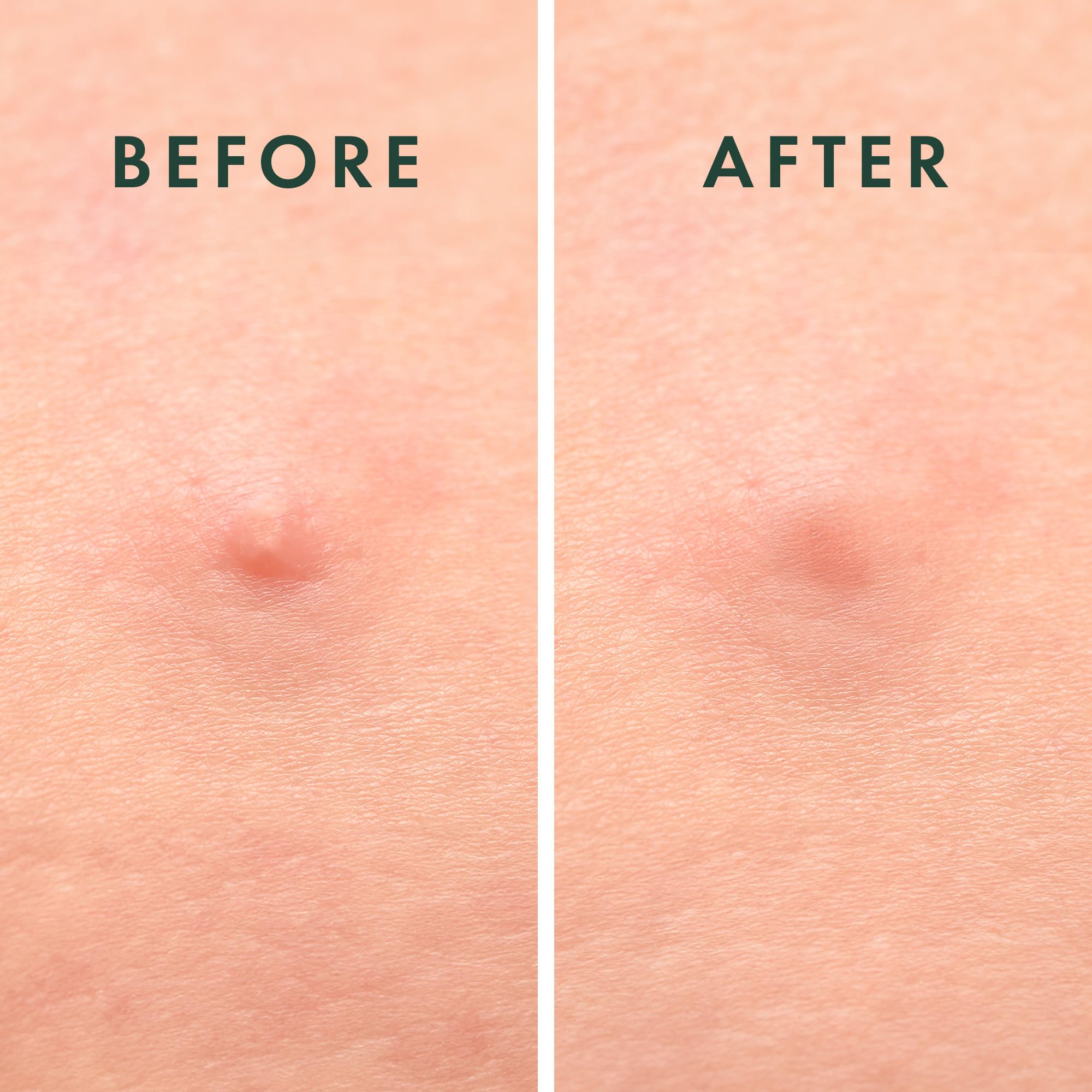 Rael Pimple Patches graphic shows hyaluronic and succinic acids for hydration.