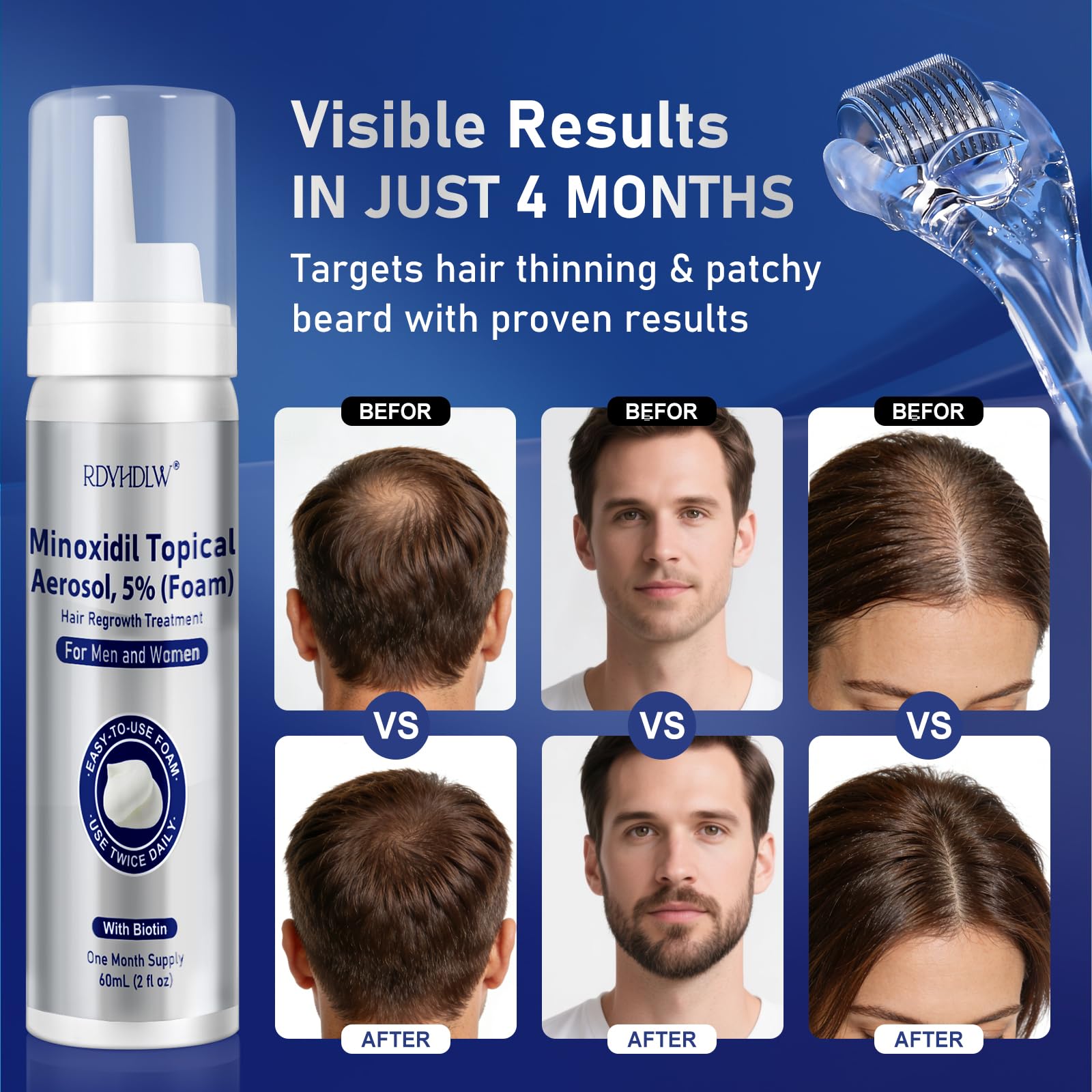 RDVHDLW Minoxidil Foam, rouleau dermo inclus pour préparer le cuir chevelu et favoriser l'absorption