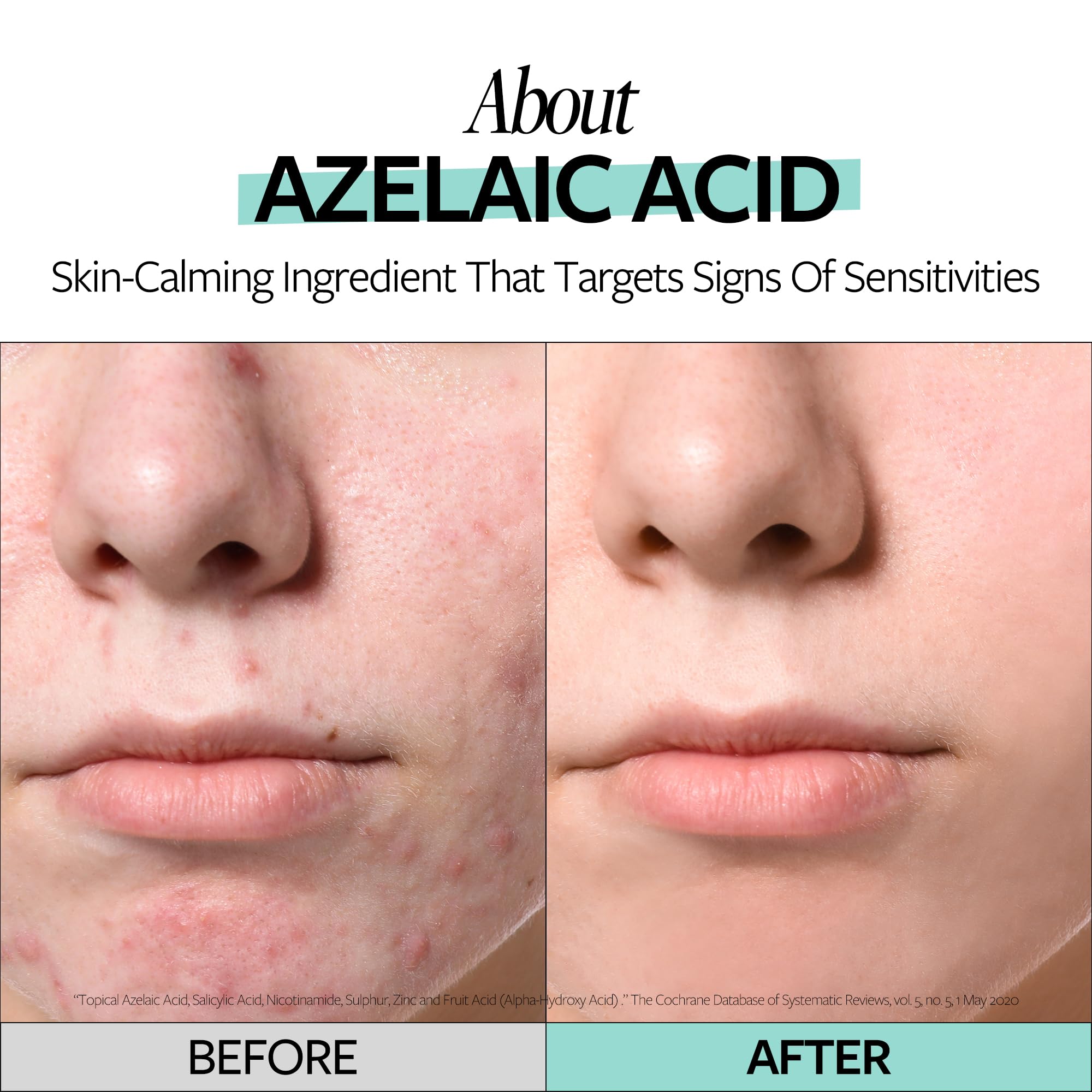 RE:CIPE Azelaic Acid 10% ampoule application step, easy daily care.