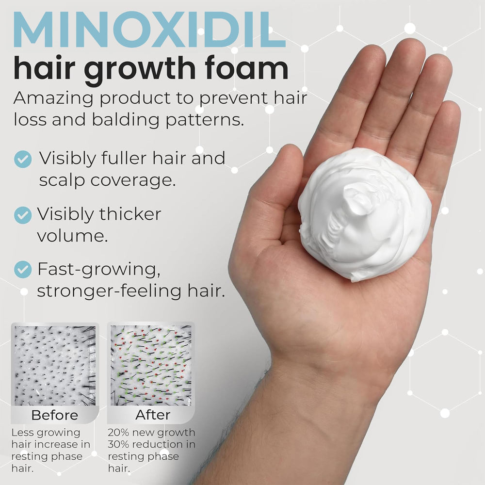 Remixidil Men’s 5% Minoxidil Foam application during morning routine for hair care