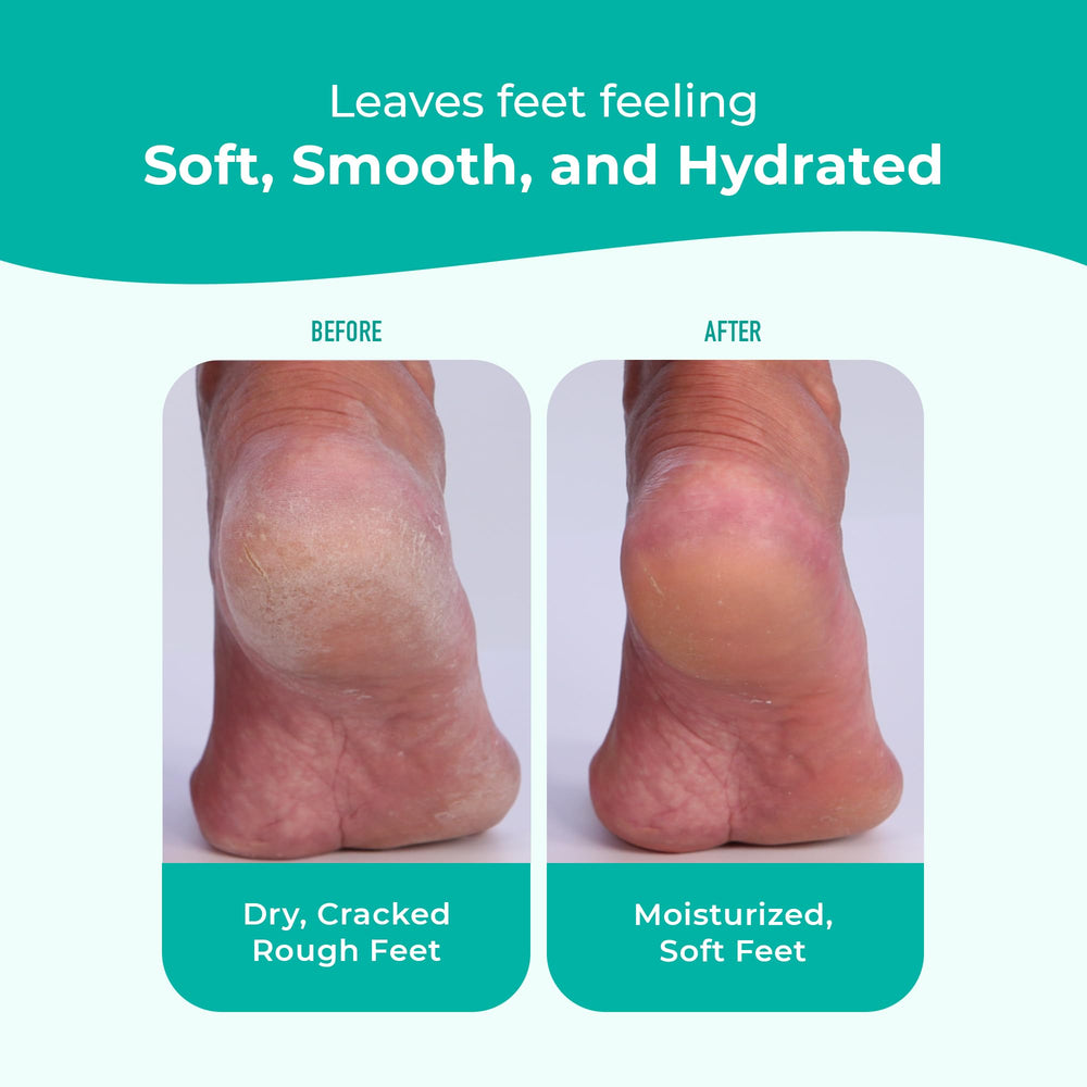 Richenna EZ Foot Care Cream delivers smoother heels after use.