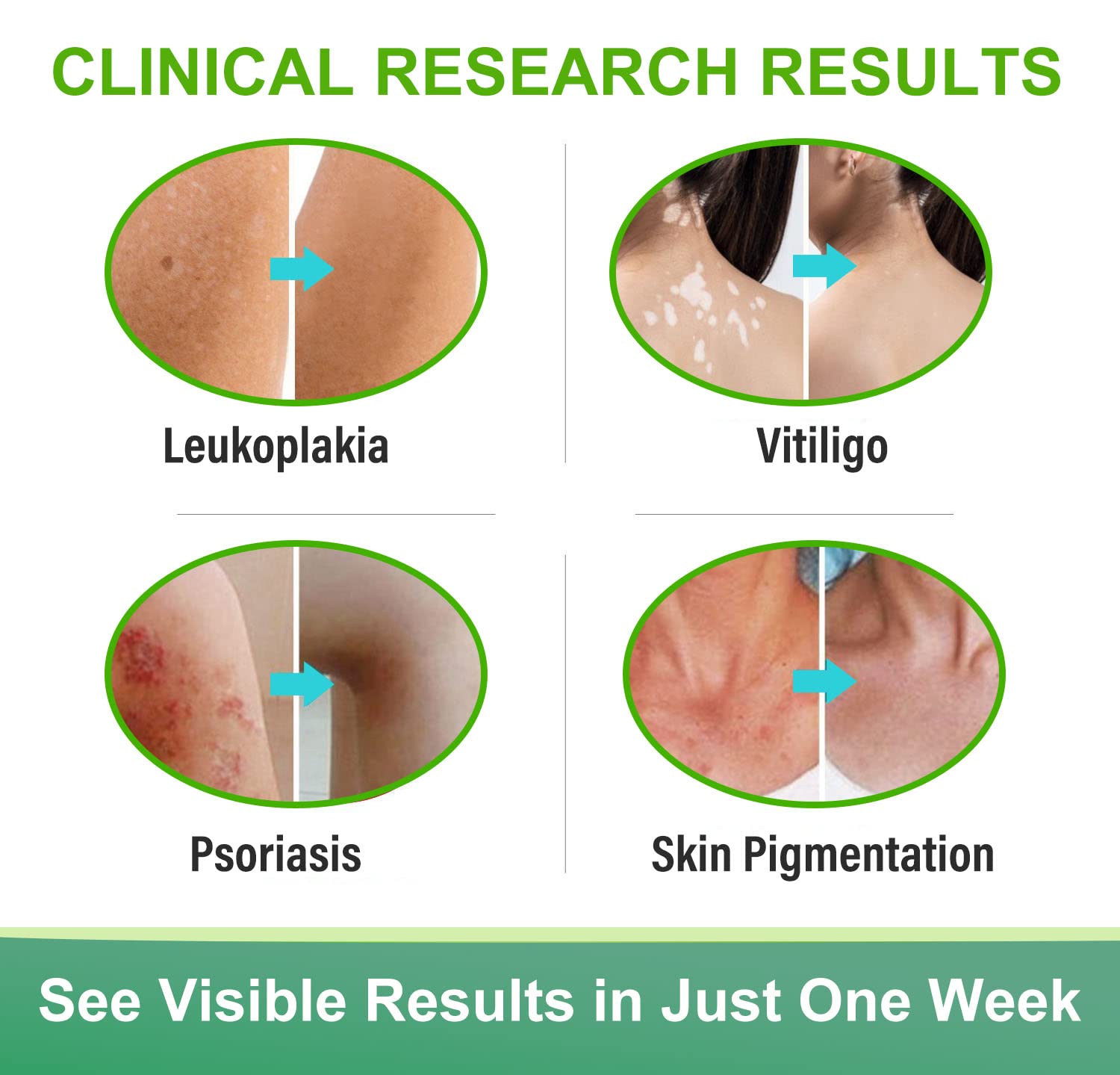 Richie House Vitiligo Cream on affected skin area — may promote a more even tone over time.