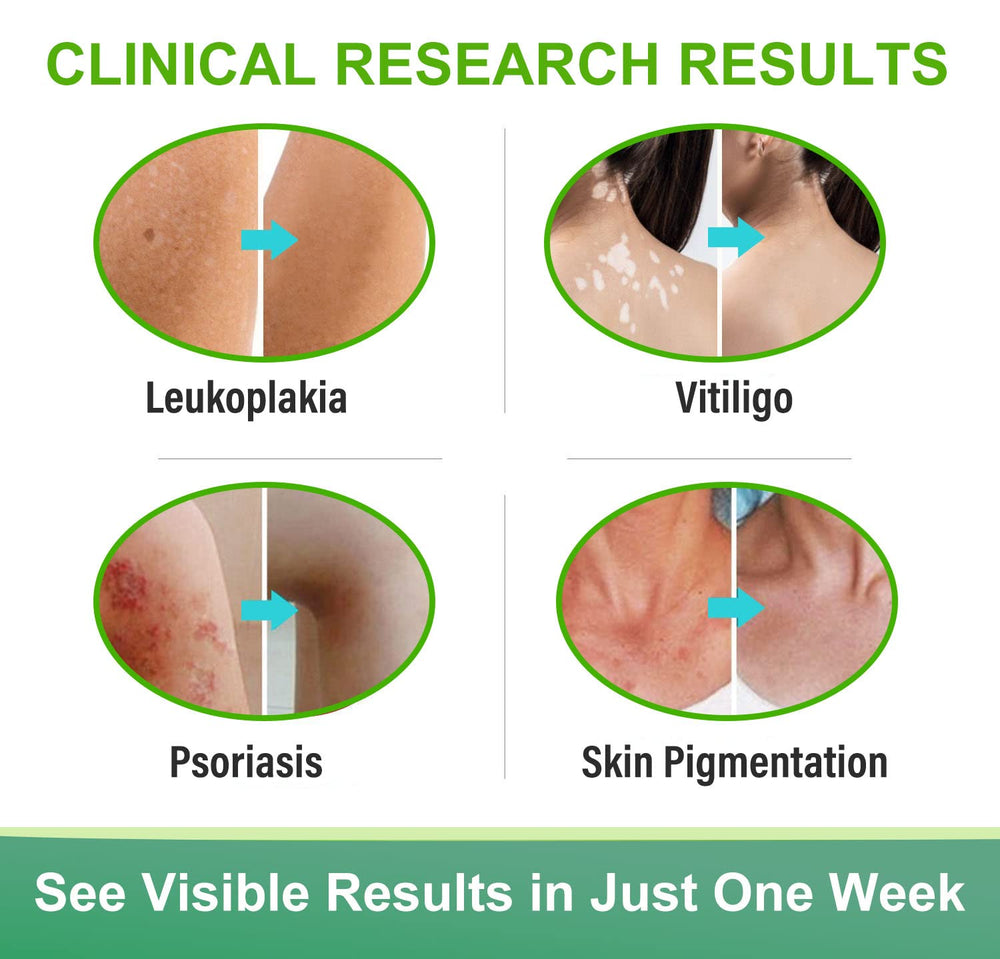Richie House Vitiligo Cream on affected skin area — may promote a more even tone over time.