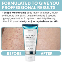 Rida KP Bump Eraser includes glycolic acid for skin renewal