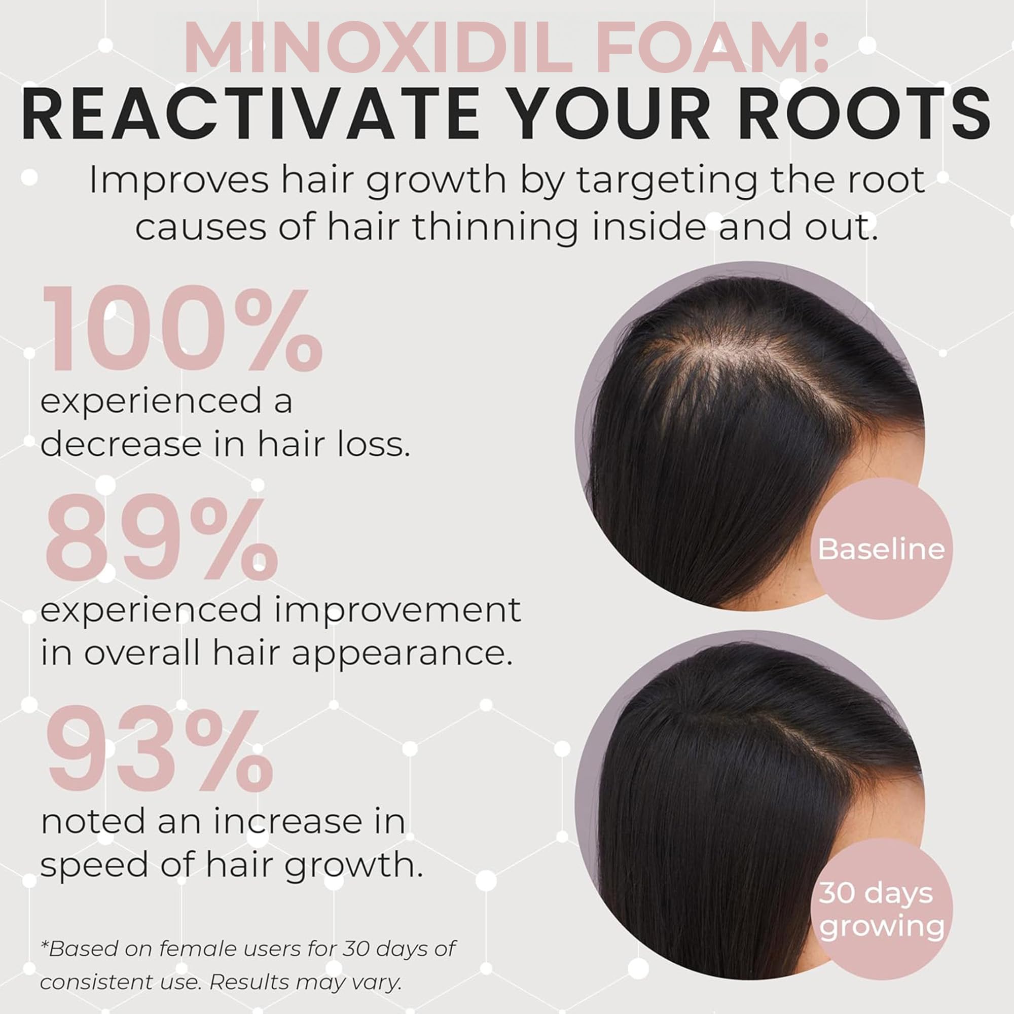 Rida Minoxidil foam applied to the scalp for thinning areas.