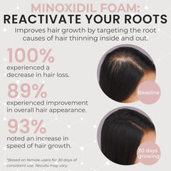 Rida Minoxidil foam applied to the scalp for thinning areas.