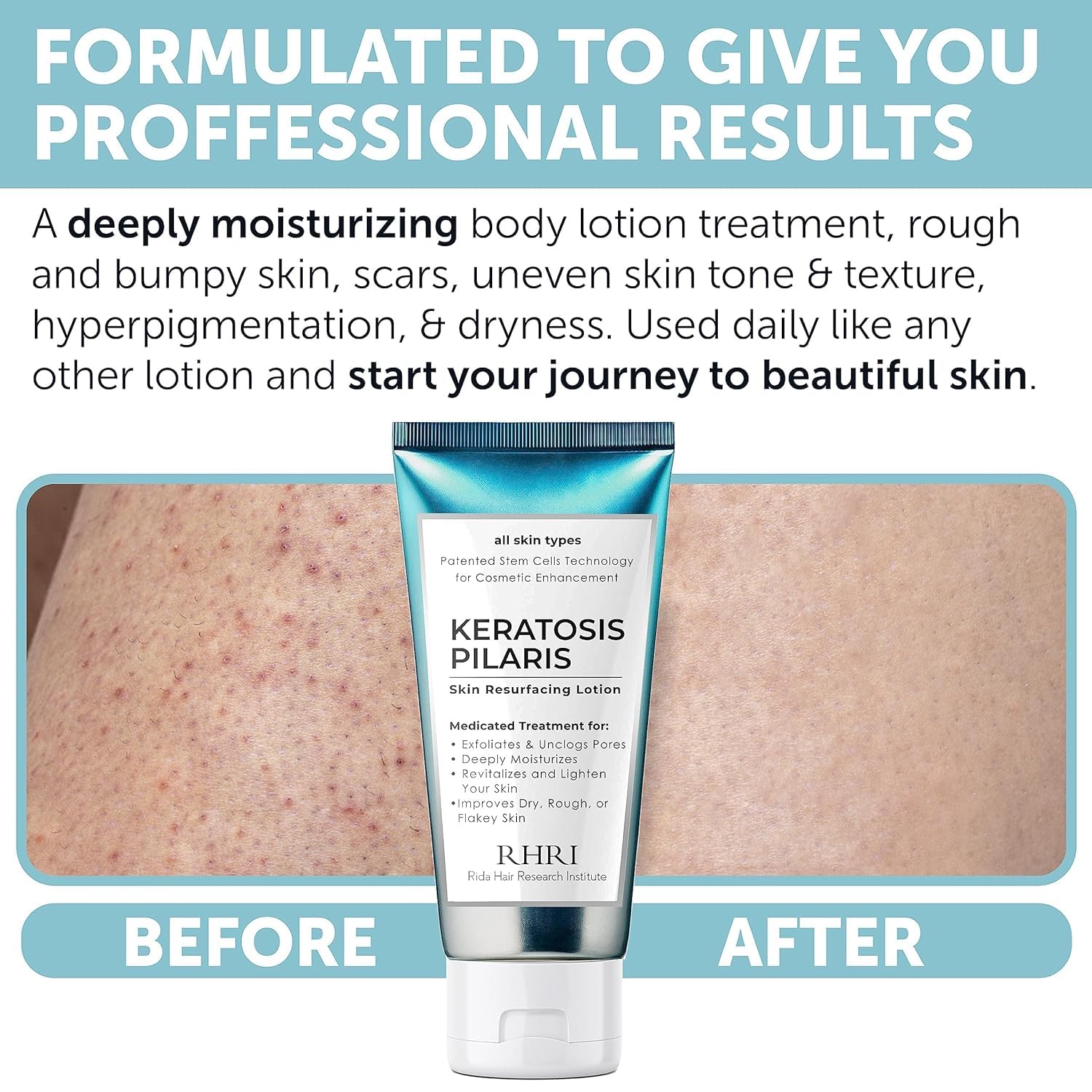 Rida Hair Keratosis Pilaris Lotion demonstrates glycolic acid exfoliation.