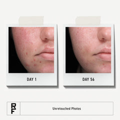 Rodan + Fields Spotless Daily Acne Wash foam promotes clean, balanced skin.