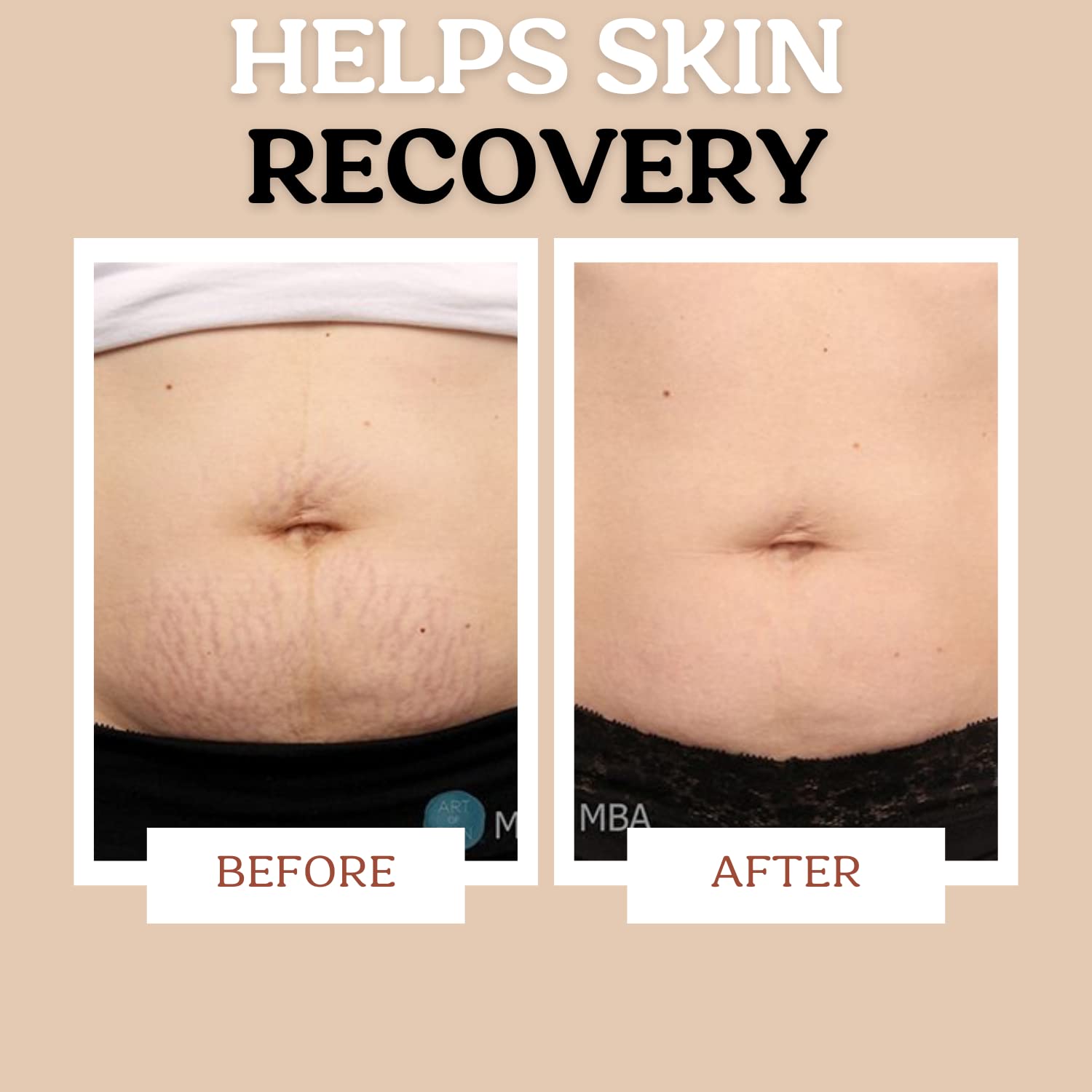 Daily-use Roe Wellness stretch mark cream enhances skin hydration and elasticity