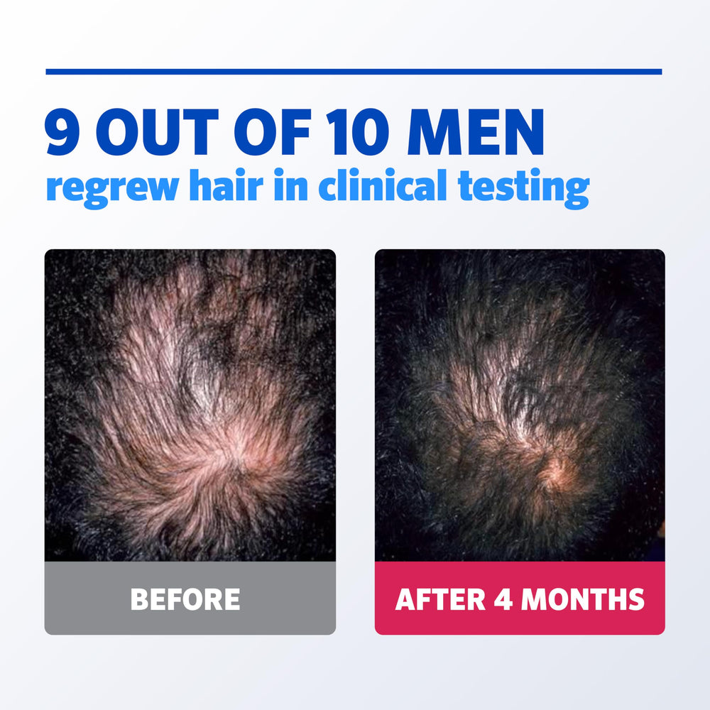 Rogaine foam massage on scalp supports follicle activity during routine.