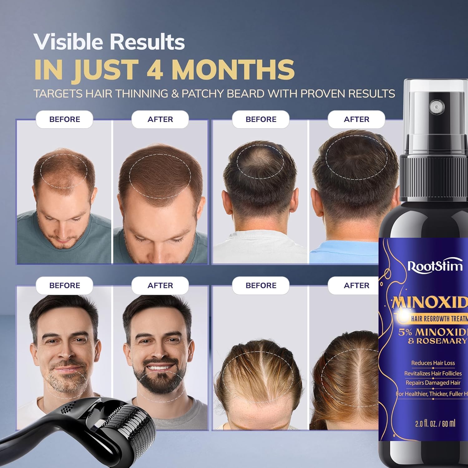 RootStim precision application tip enables targeted thinning-area dosing.