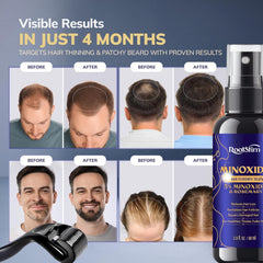 RootStim precision application tip enables targeted thinning-area dosing.