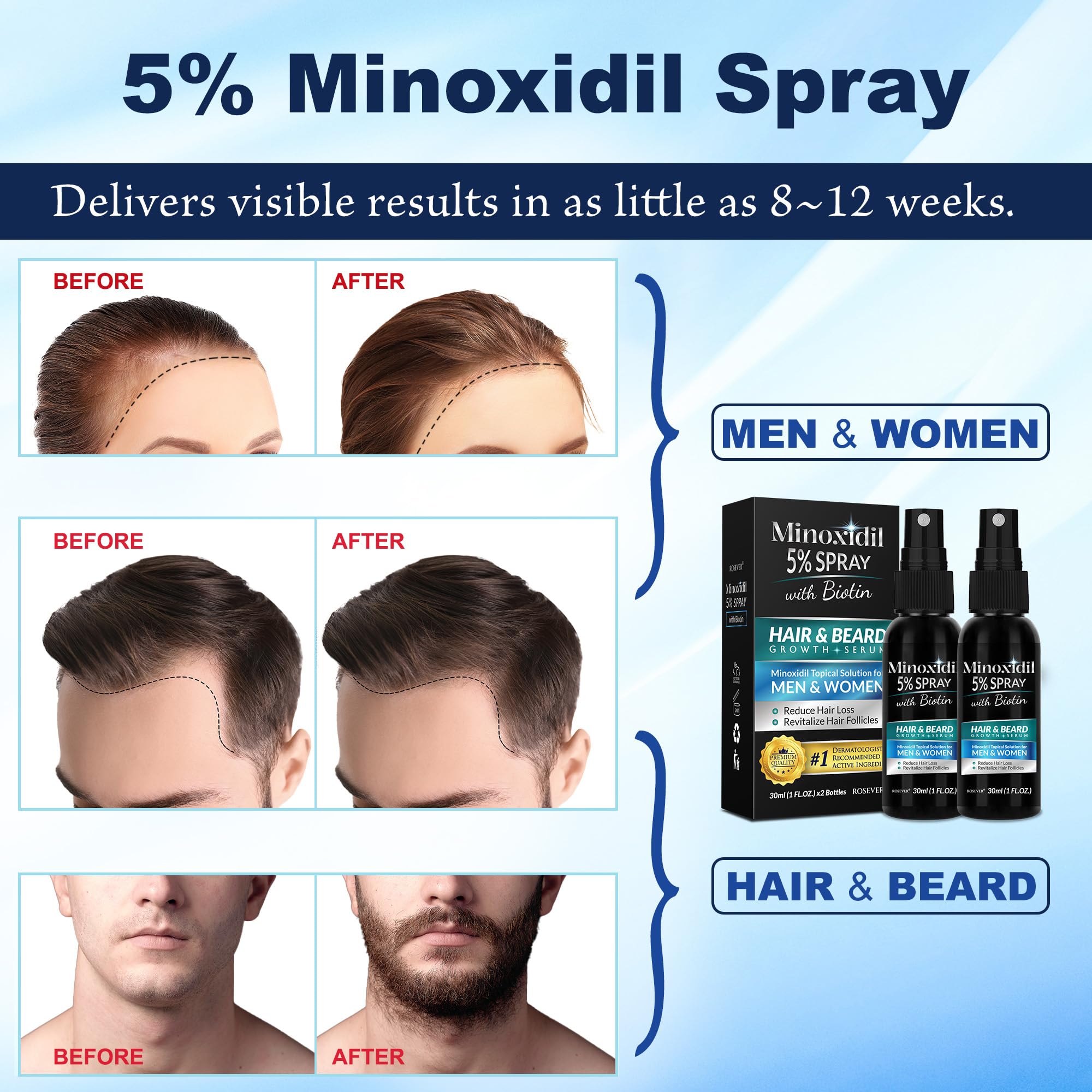 Rosever Minoxidil spray application for men shows simple daily use.