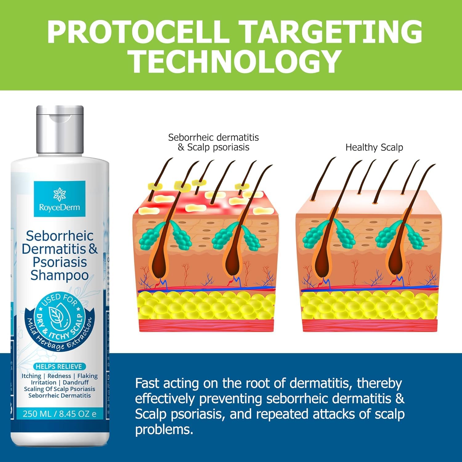 Roycederm Psoriasis Shampoo foam close-up indicates gentle application
