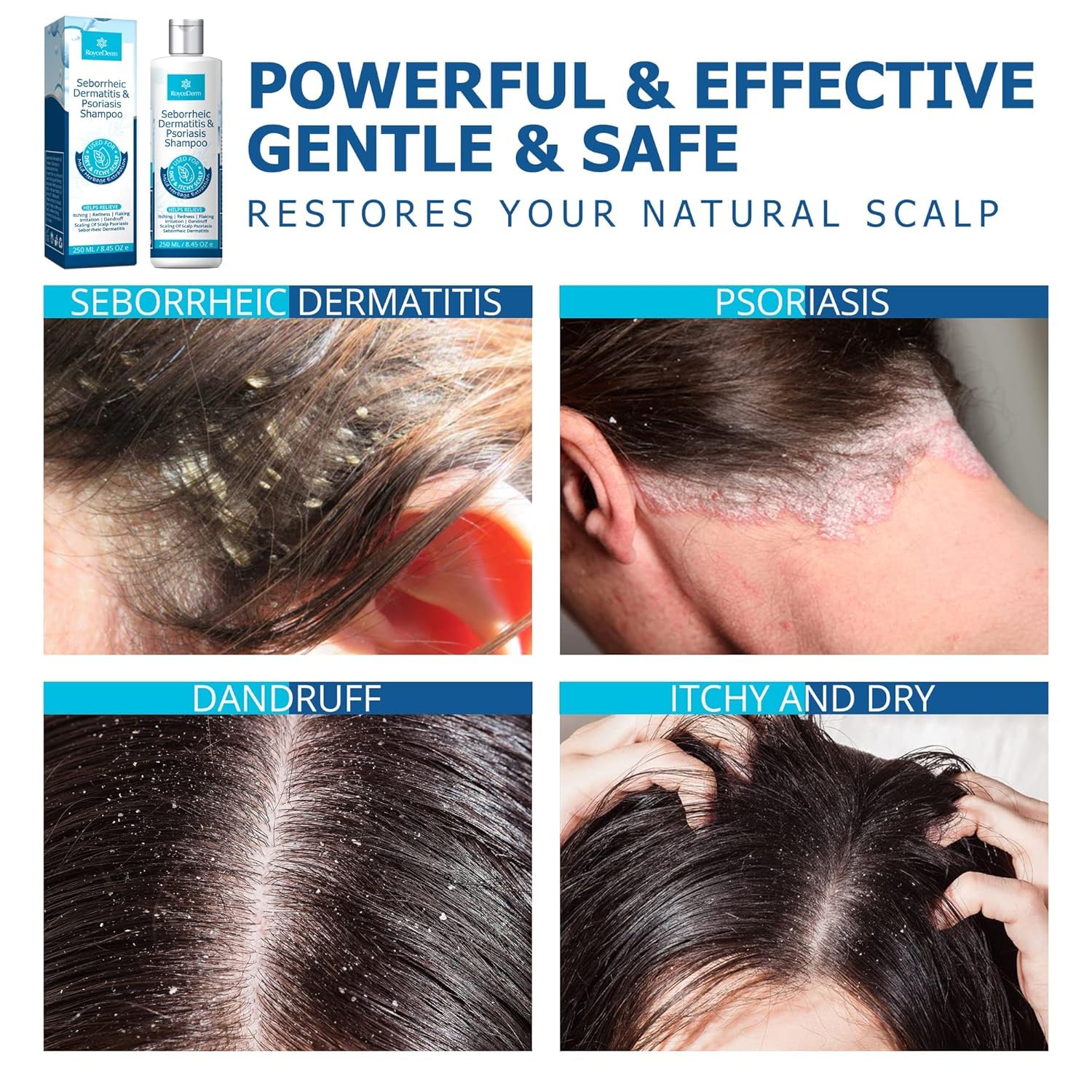 Roycederm Psoriasis Shampoo packaging highlights safe, premium scalp care