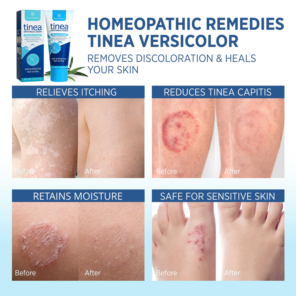 Roycederm tinea treatment label highlights multi-functional antifungal properties for humans