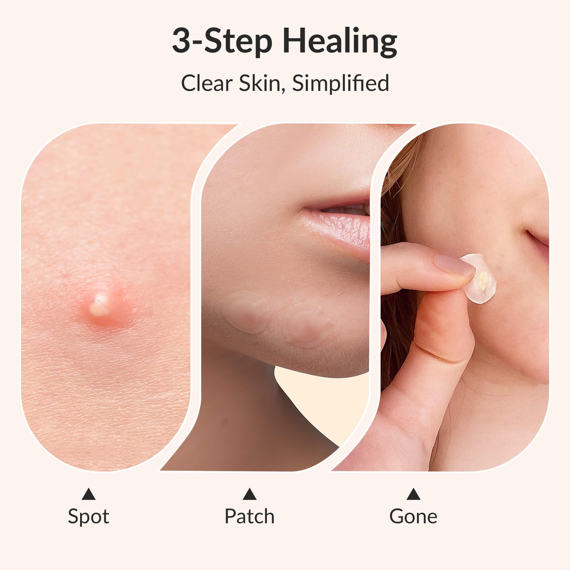 RPE Life advanced 15mm patch fits mid-size breakouts for quick absorption.
