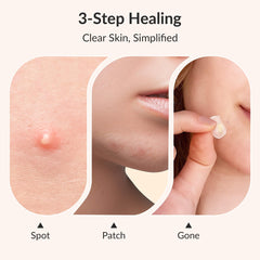 RPE Life advanced 15mm patch fits mid-size breakouts for quick absorption.