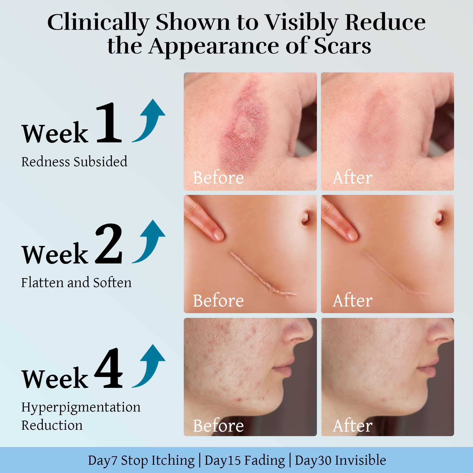 RWT Silicone Scar Cream supports smoother skin on postoperative scars.