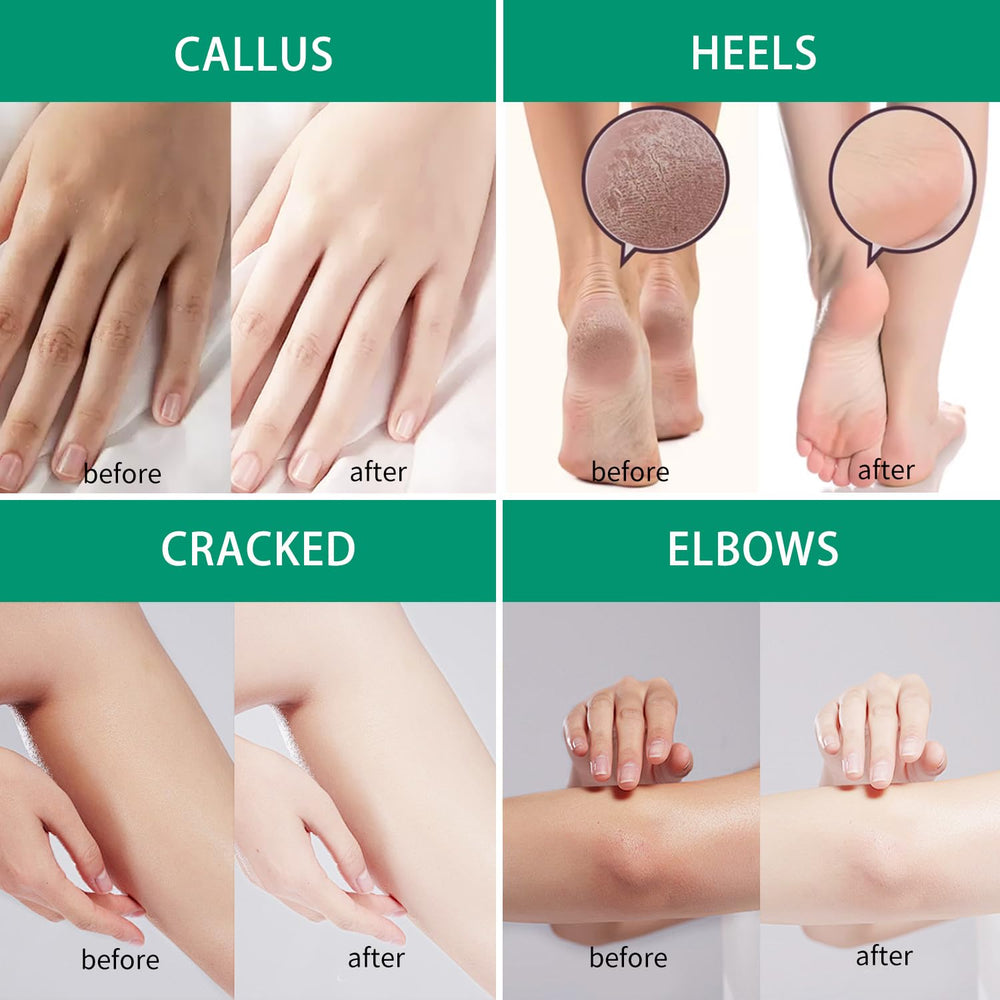 SACLLCAS Urea Cream 40% no odor, comfortable wear.