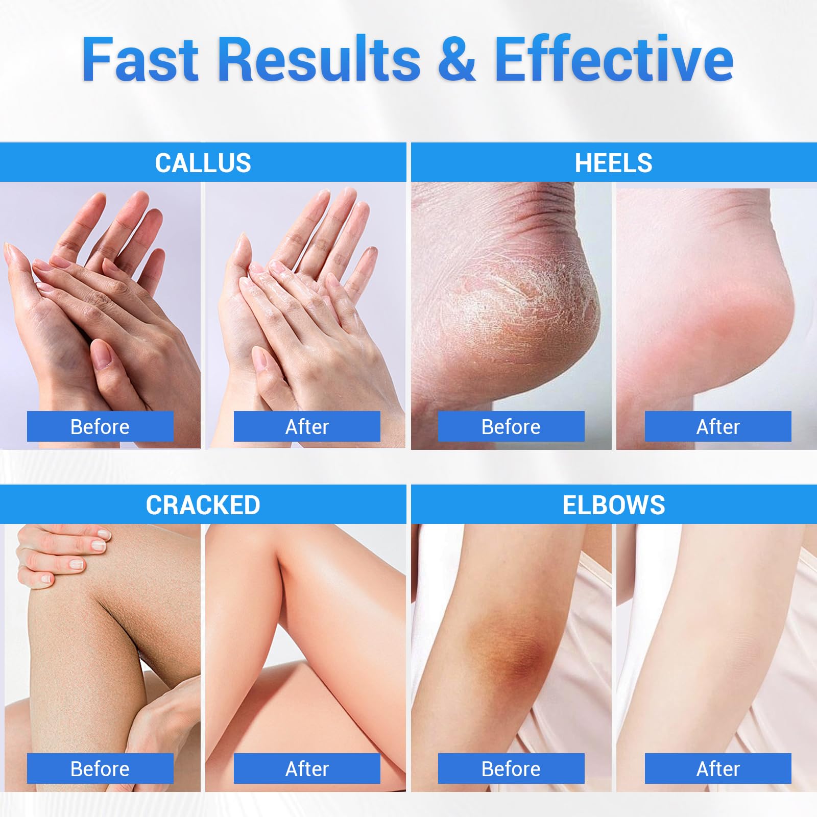 Sagry Urea 40% soft skin result on feet.