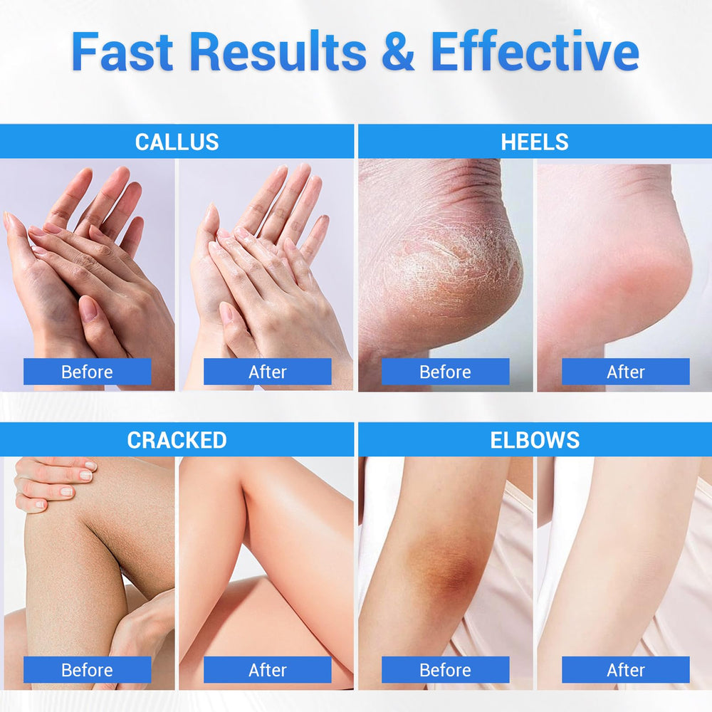 Sagry Urea 40% soft skin result on feet.