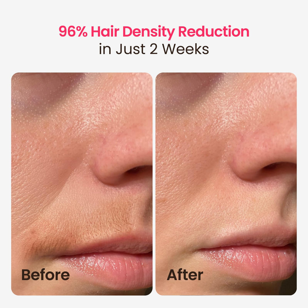 SALLOOT triple-pulse IPL full-body session showcase for fast home treatments.