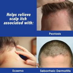 Scalpicin Max Strength fragrance-free label designed for sensitive scalps.