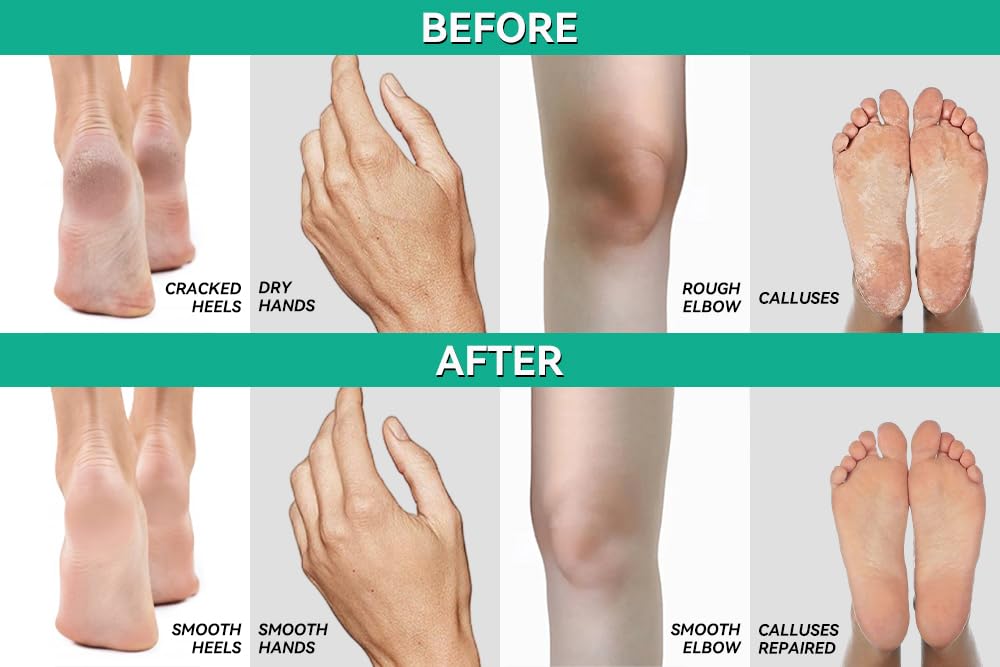 Calluses and corns softening with dense gel texture.