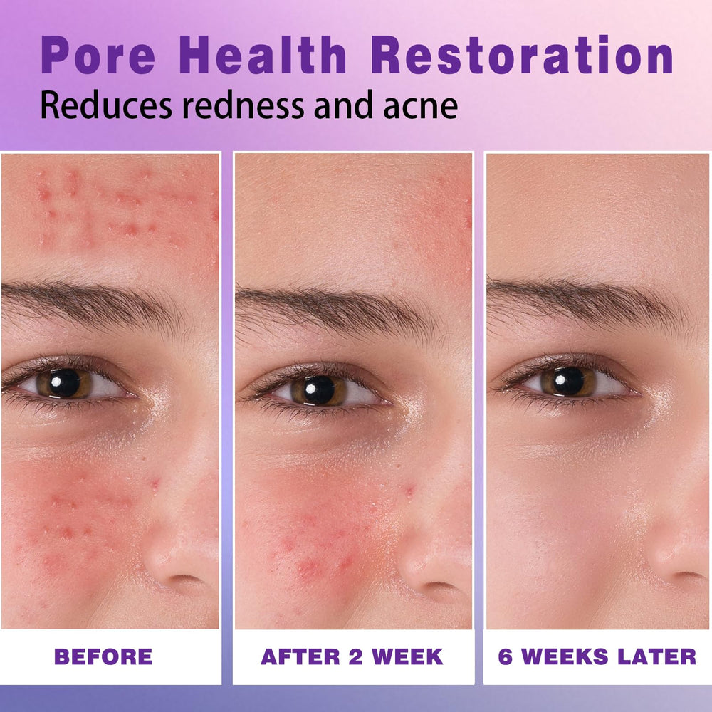 Sefralls azelaic acid cream applied on skin shows lightweight absorption and redness relief.