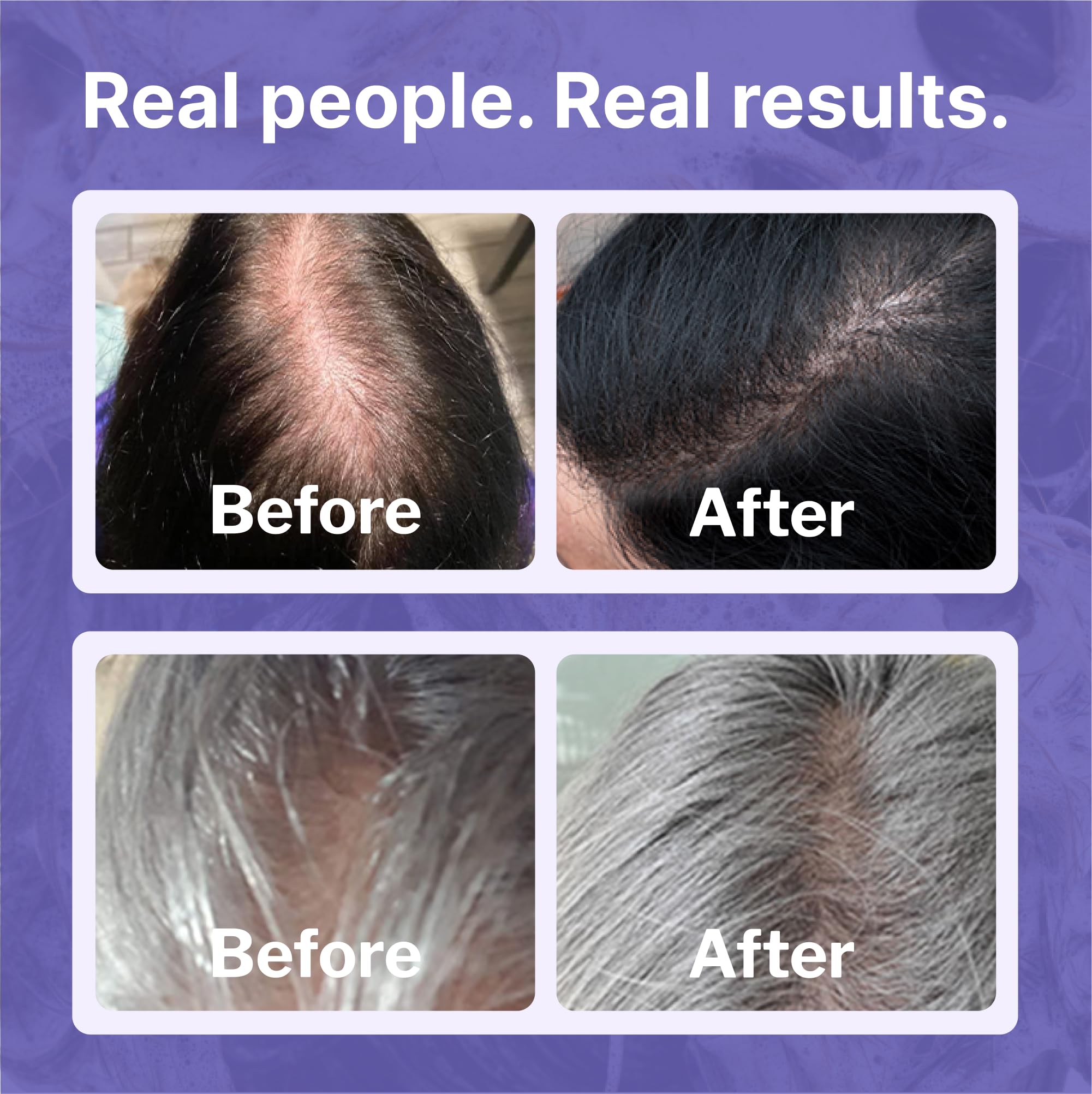 Shapiro MD Minoxidil 2% scalp massage for absorption.