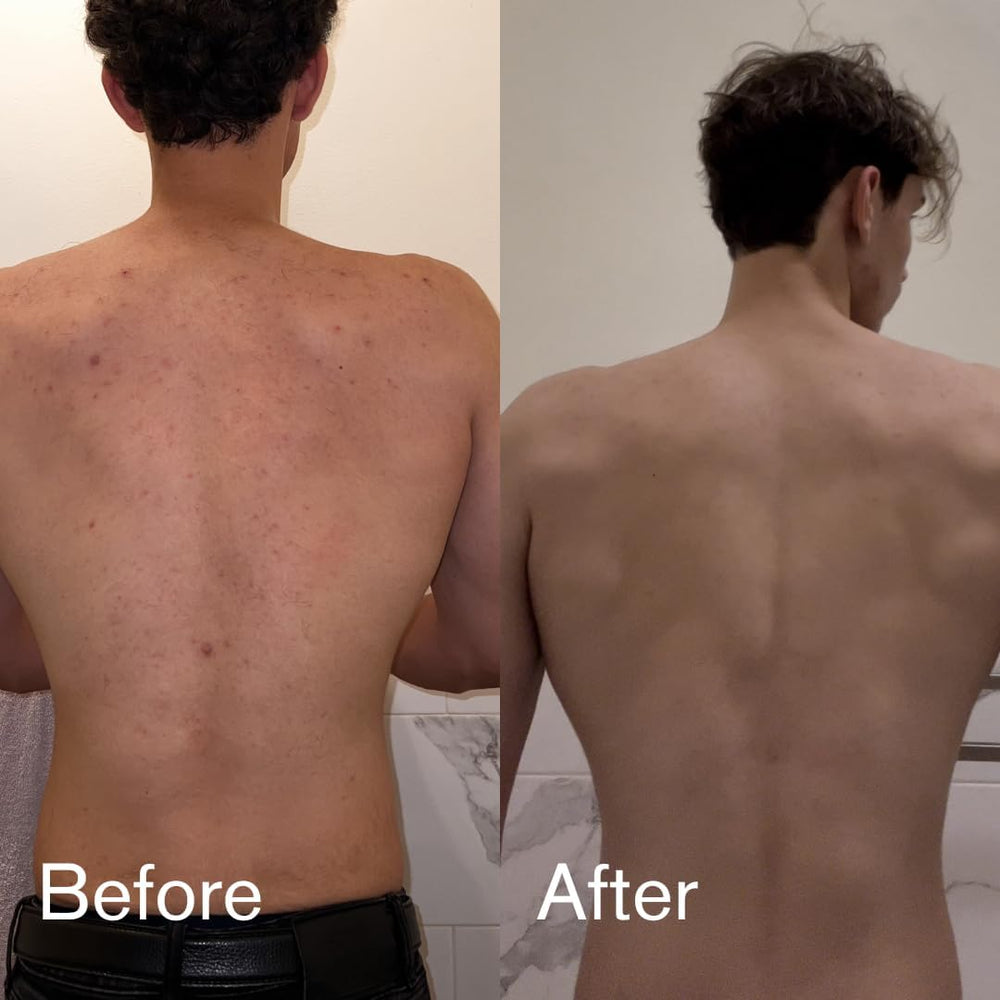 Shield Body Acne Wash after-gym cleansing helps remove sweat and oil.