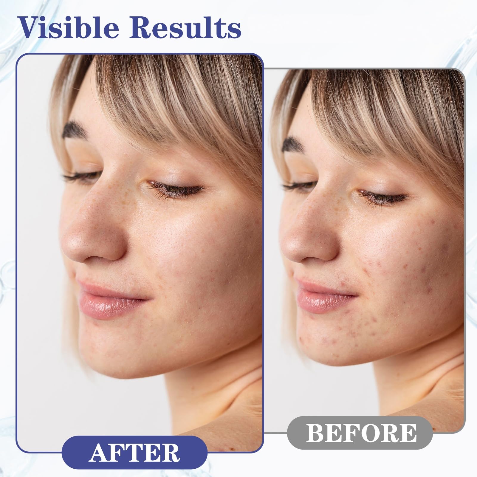SINPIN AOBENZ Control Gel with 2% salicylic acid helps cleanse pores.
