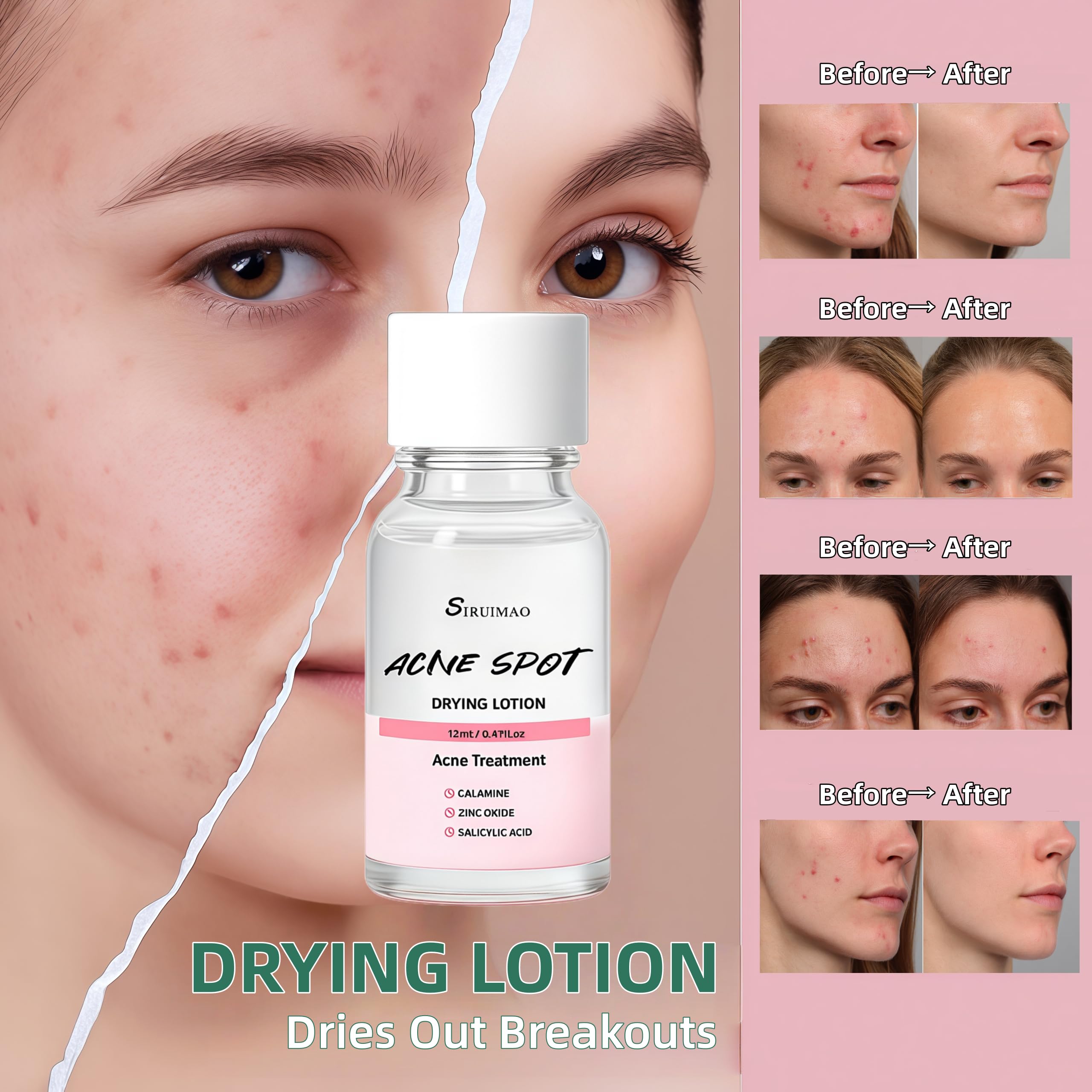 SIRUIMAO bottle with swab shown for convenient night-time blemish care.