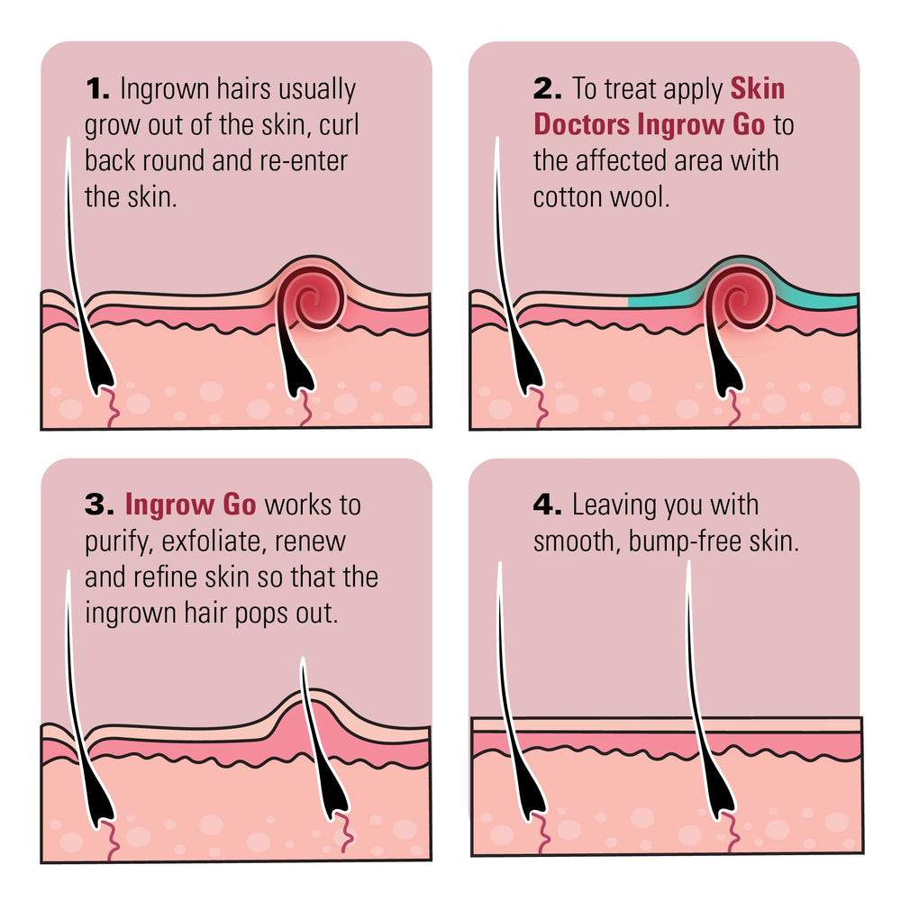 Skin Doctors Ingrow Go Lotion helping cleanse pores and release trapped hair