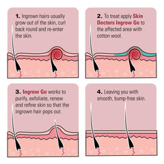 Skin Doctors Ingrow Go Lotion helping cleanse pores and release trapped hair