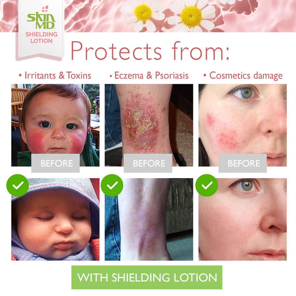 Skin MD Shielding ingredients list highlights natural botanicals for nourishment.