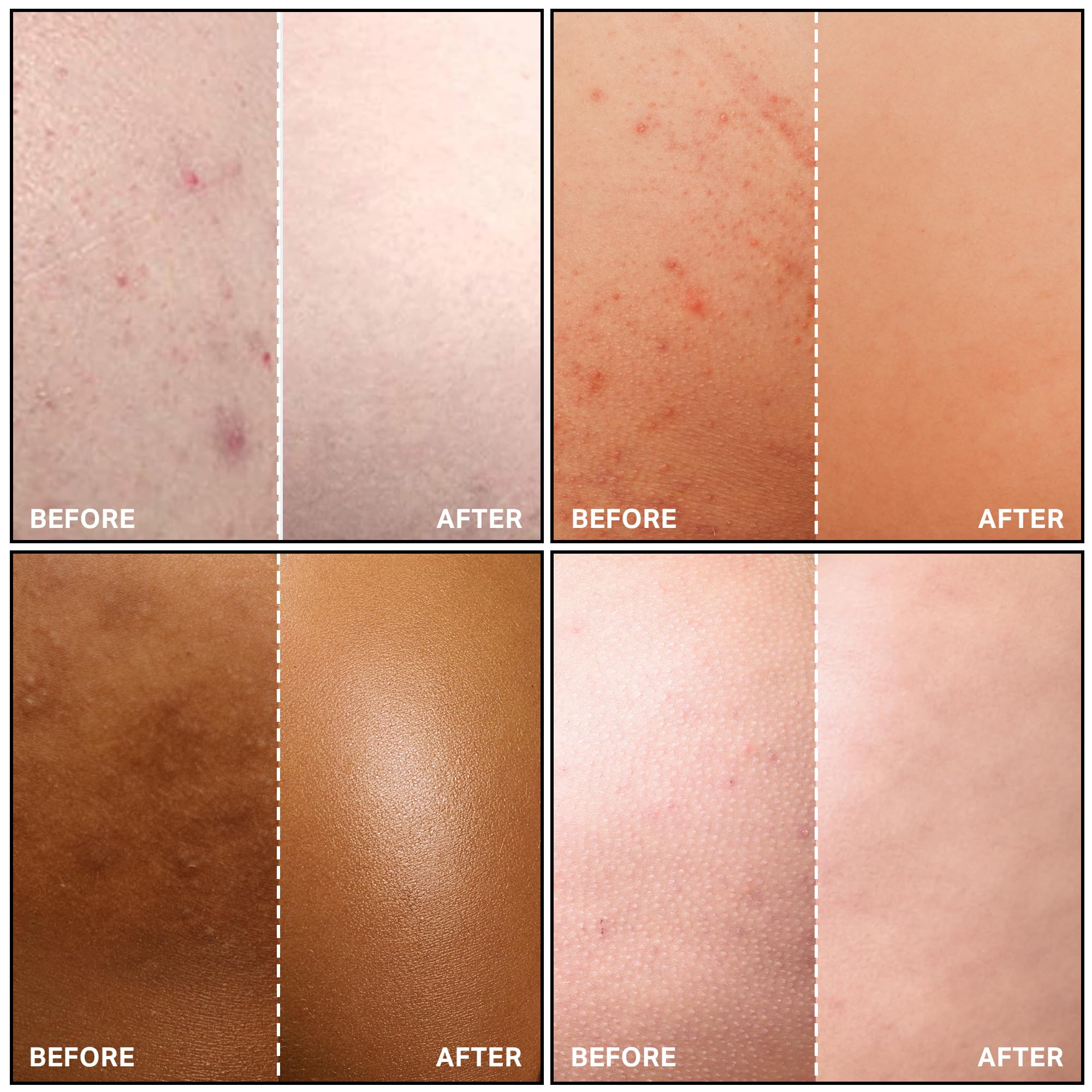Gift-pack scene featuring SKINBOSS Butt Acne Clearing Treatment for Valentine care