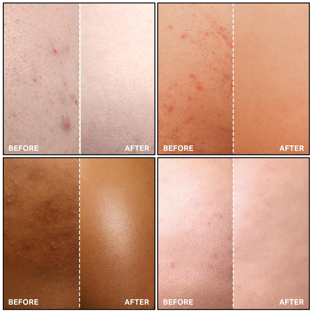 Gift-pack scene featuring SKINBOSS Butt Acne Clearing Treatment for Valentine care