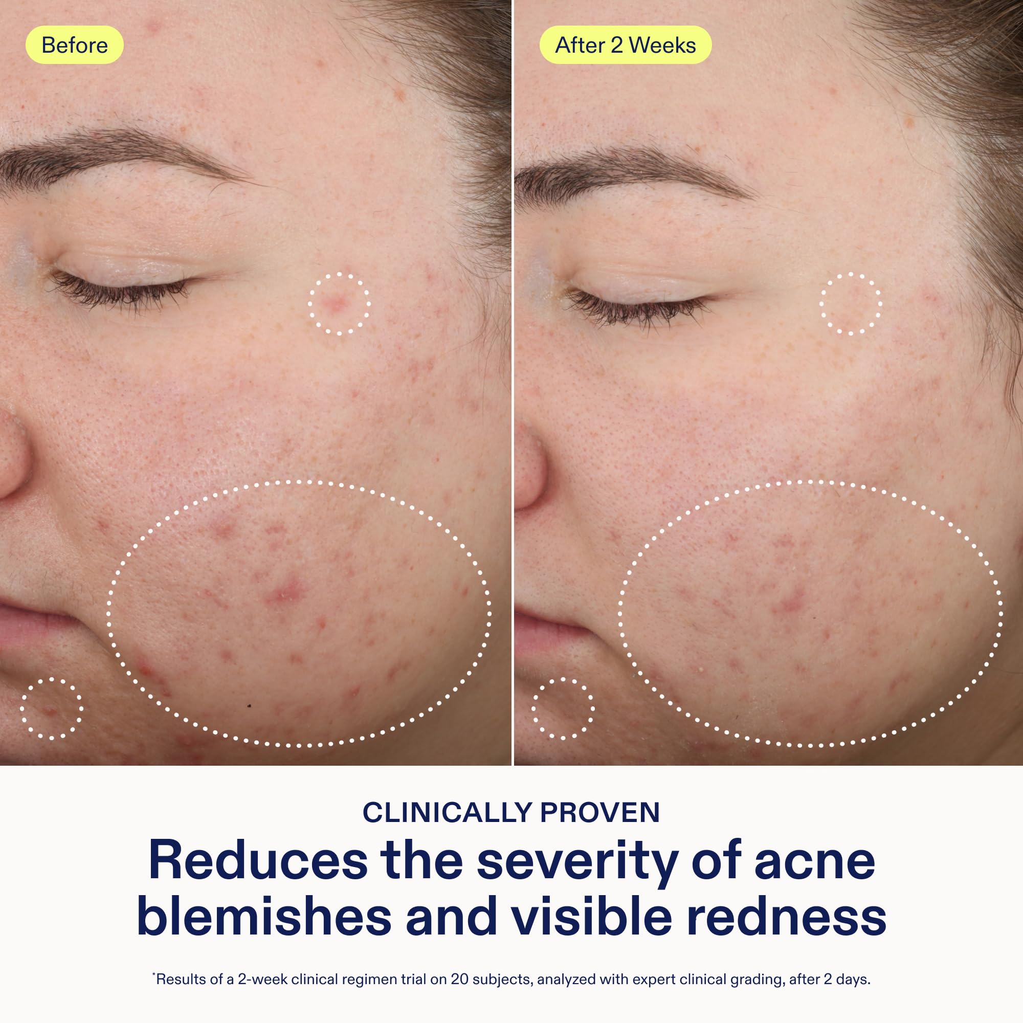 Skinfix fragrance-free formula close-up highlights azelaic and salicylic acids benefits
